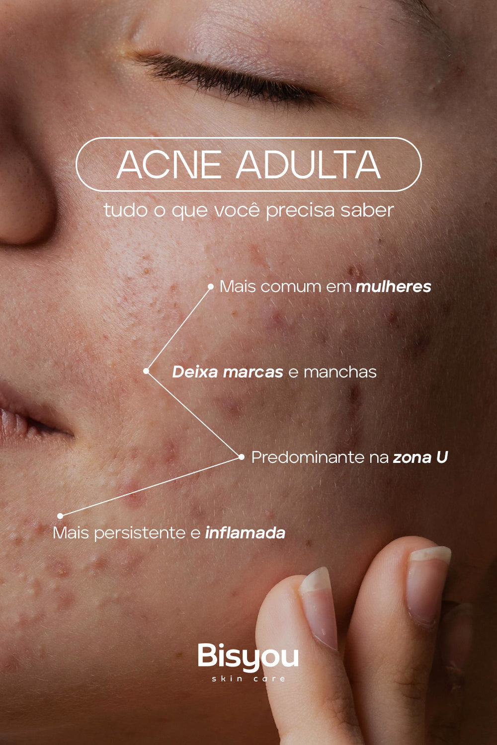 Acne adulta: como tratar, prevenir e cuidar da pele