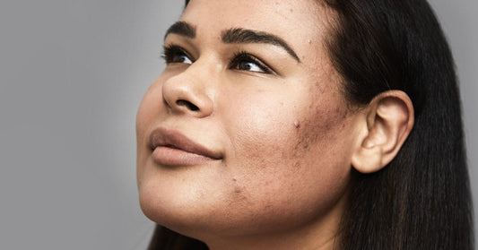 Conheça o movimento Skin Positivity