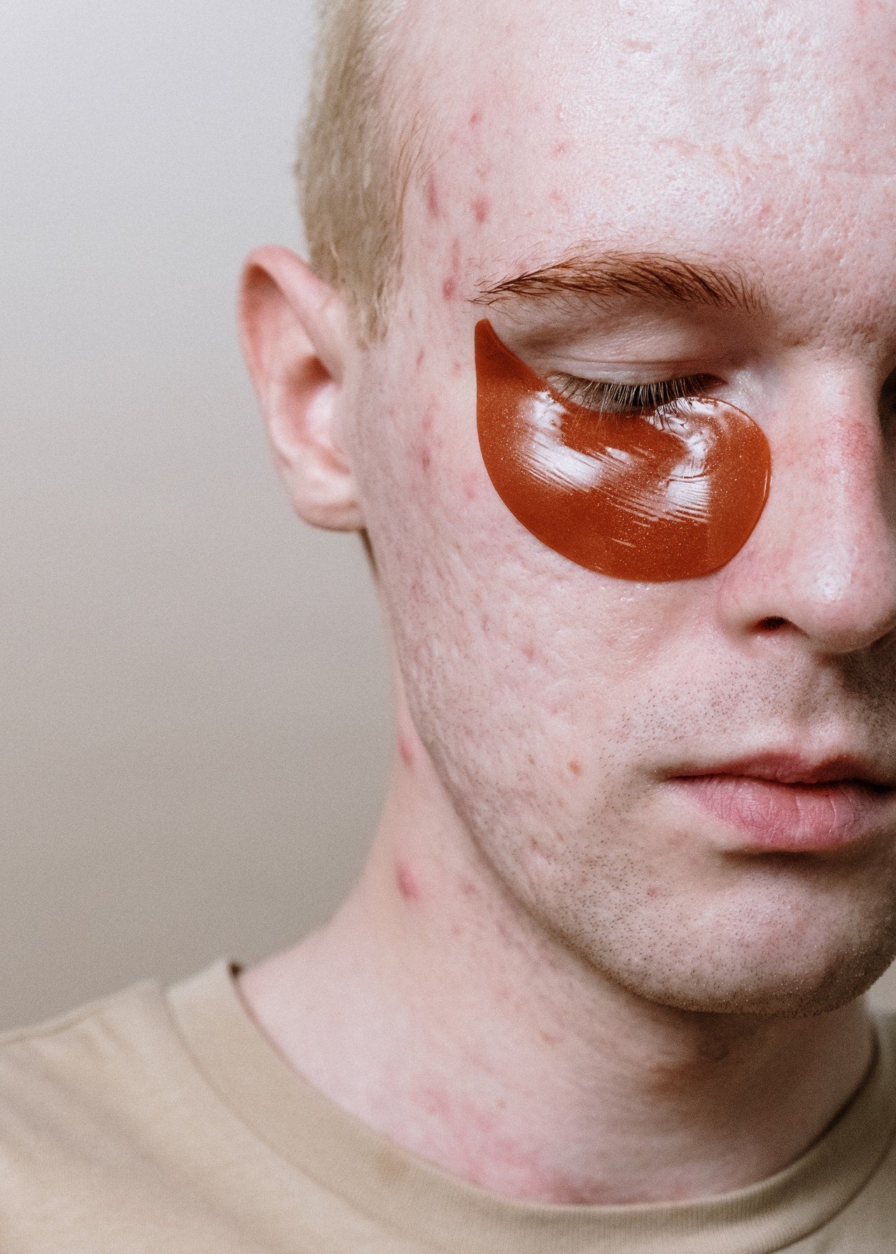 Investigando grandes mistérios do skincare: saiba tudo sobre a acne!