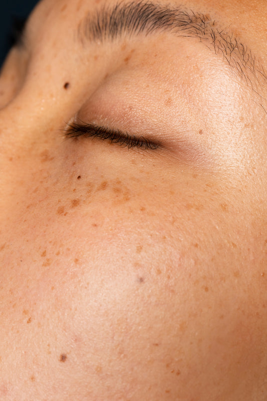 Formação, prevenção e tratamento: tudo sobre manchas e melasma