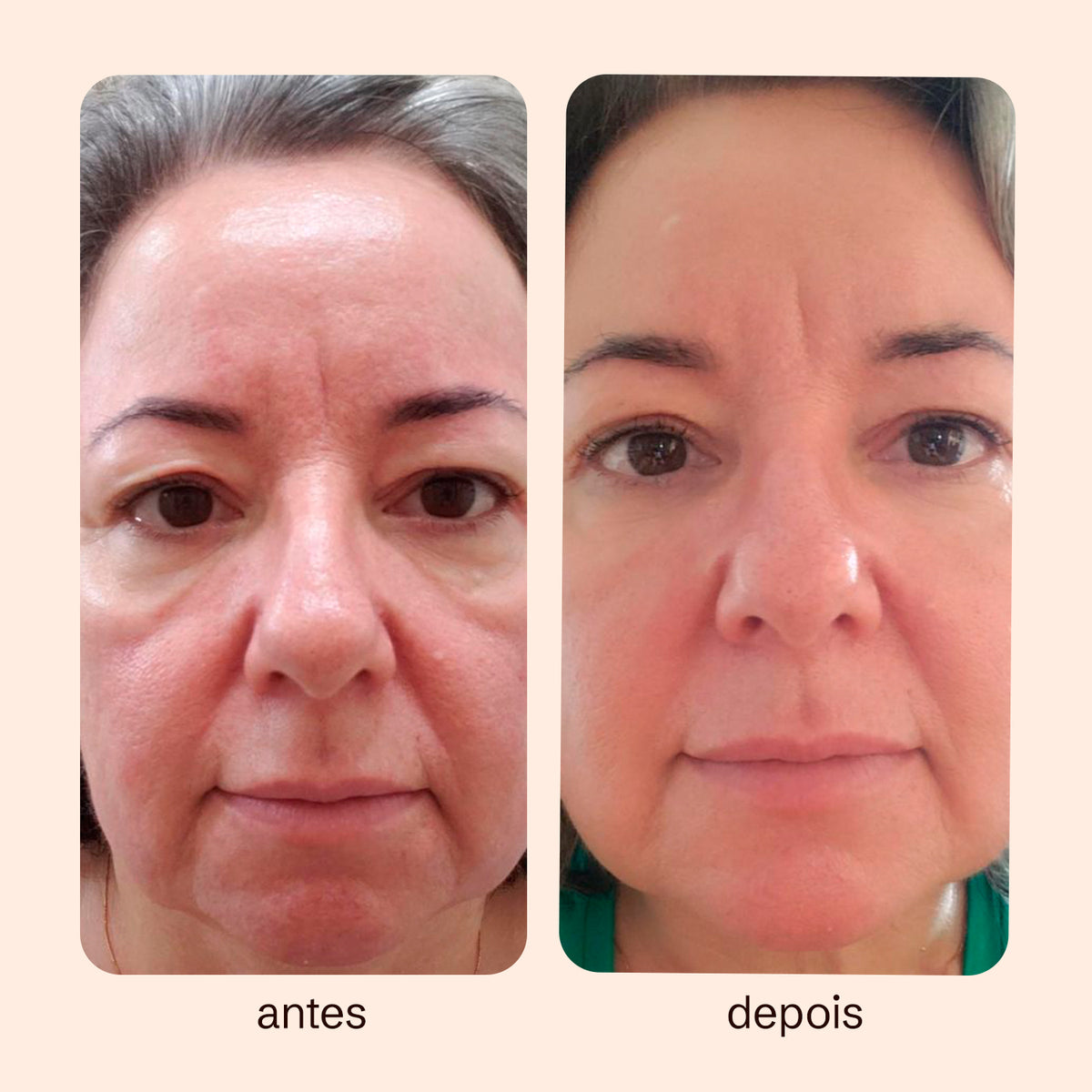 Preenchedor Facial em Gel