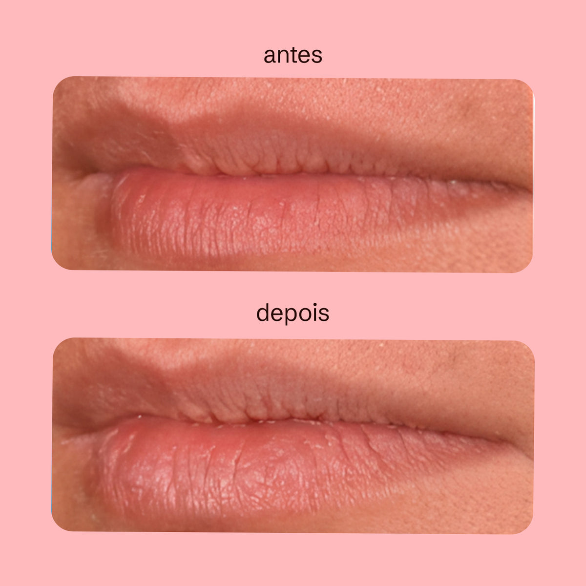 Preenchedor Labial