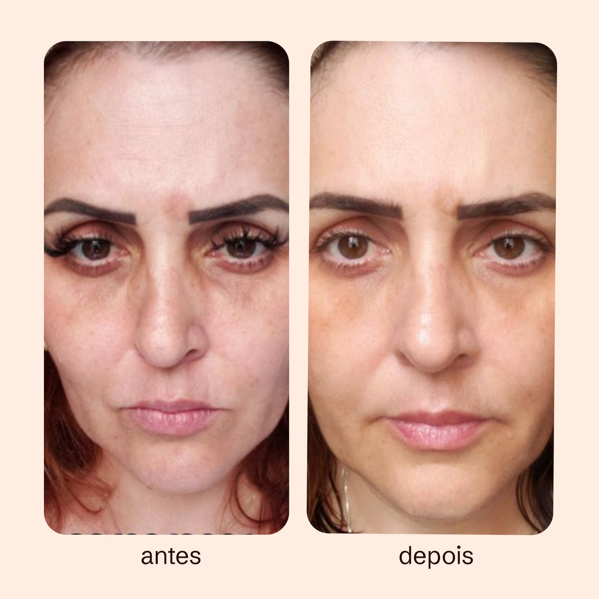 Preenchedor Facial em Creme