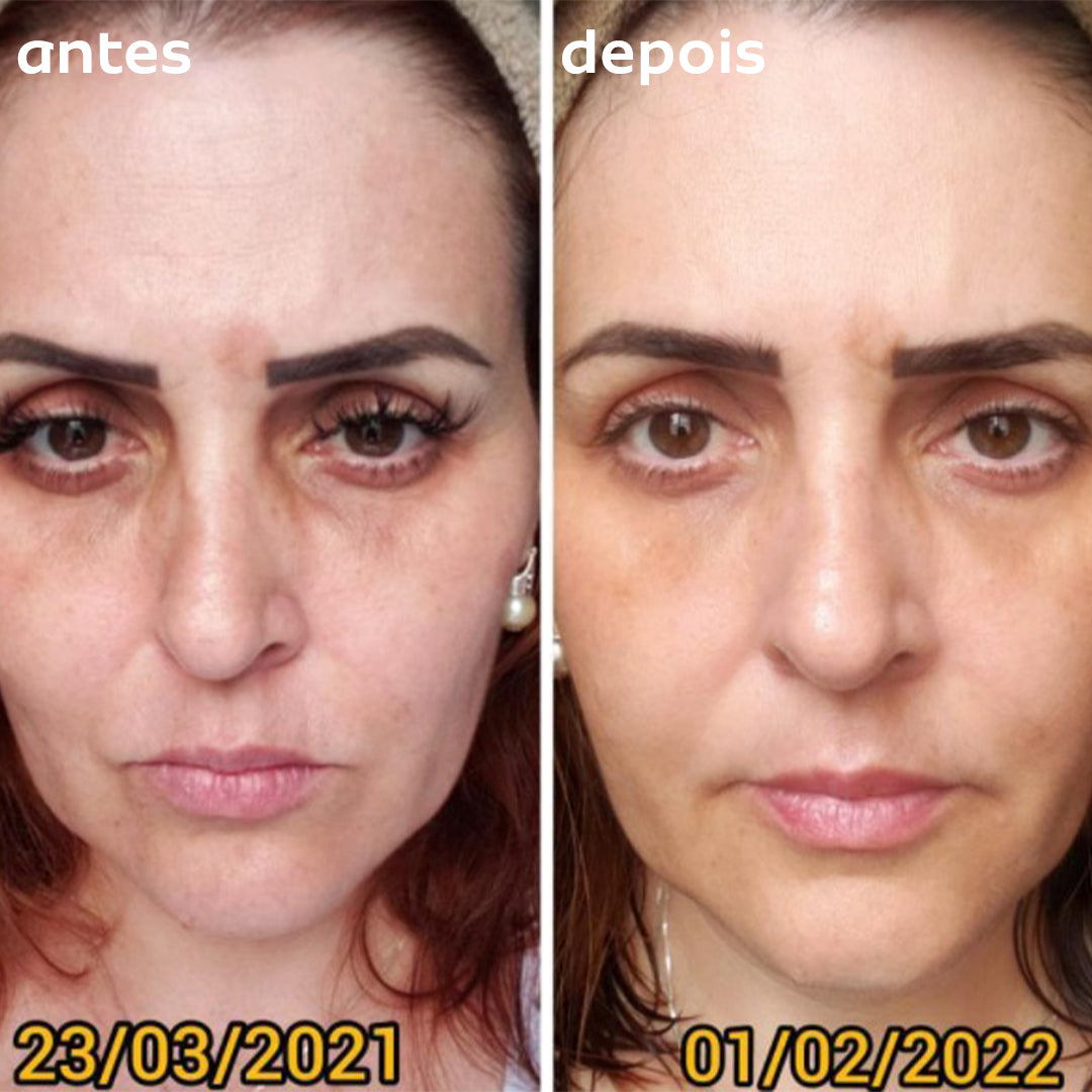 Preenchedor Facial em Gel Bisyou